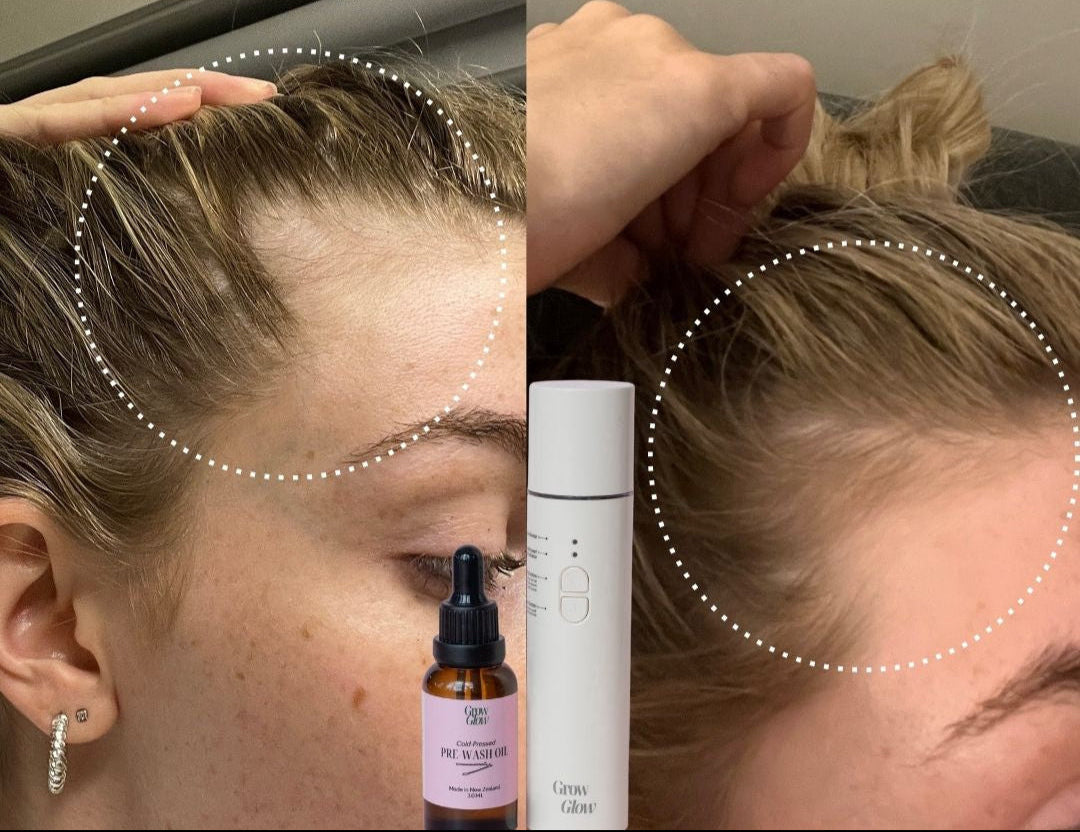 Hair Transformation using Grow Glow Hair and scalp Oil with hair growth.