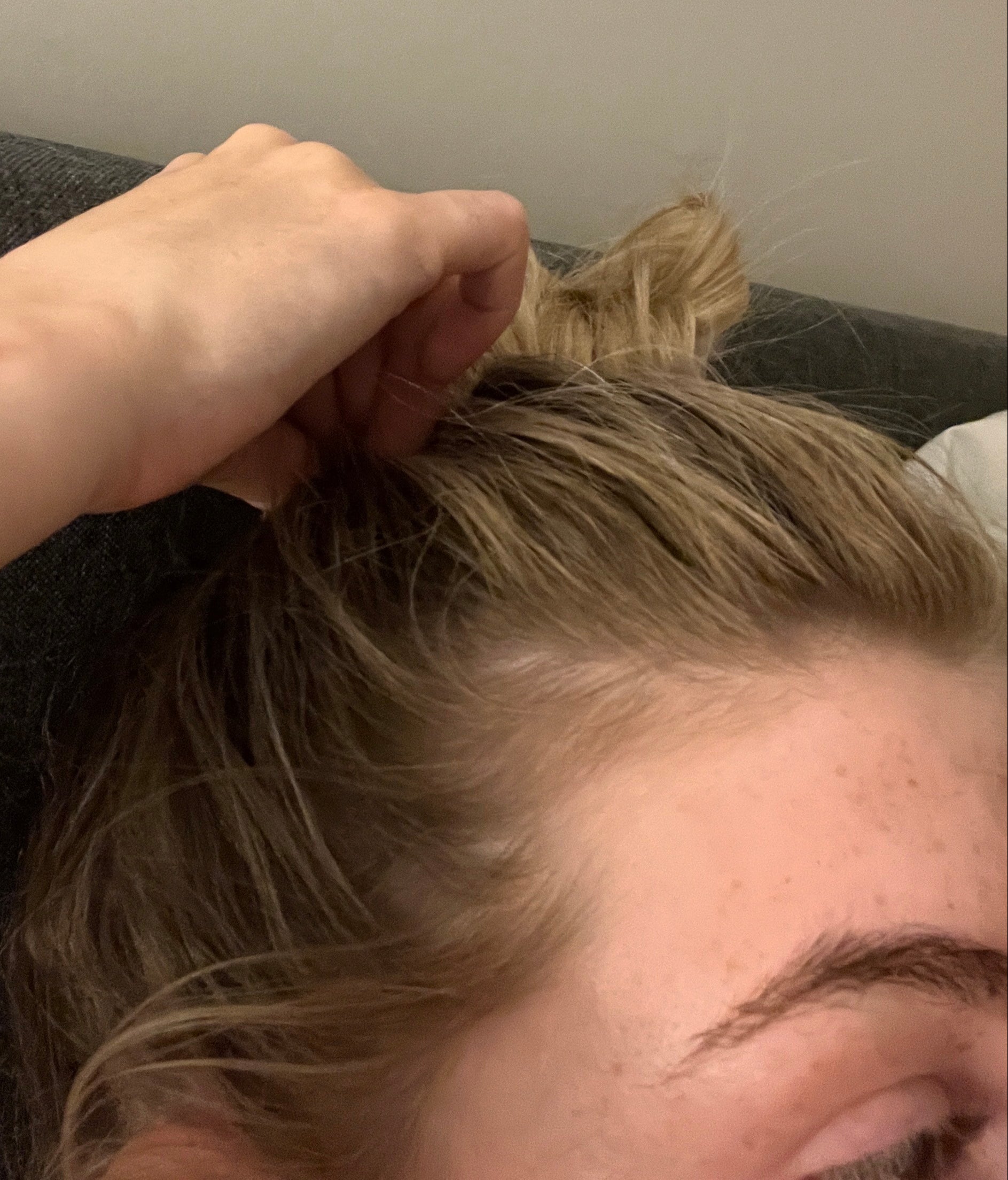Before and after photo showing significant improvement in hair growth on bald patches after regular scalp care and hair oiling.