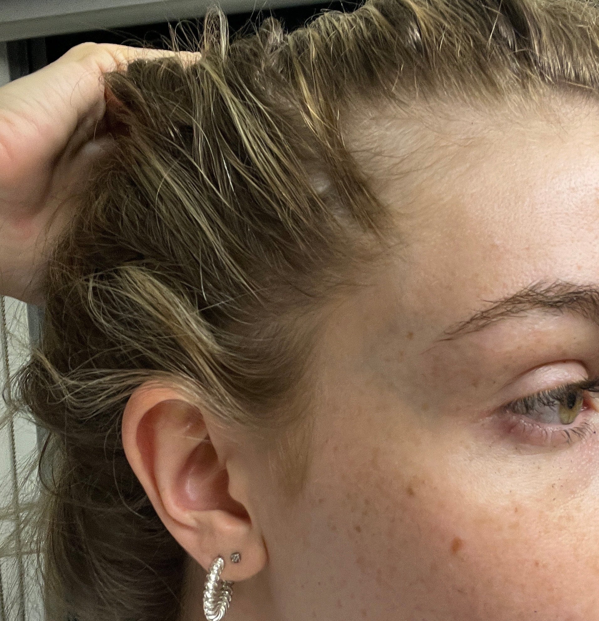 Before and after photo showing significant improvement in hair growth on bald patches after regular scalp care and hair oiling.